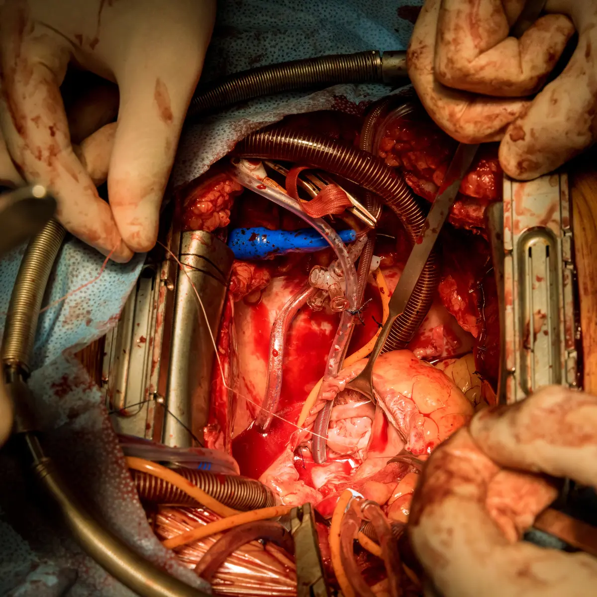 Cirugía Cardiovascular y Vascular Periférica