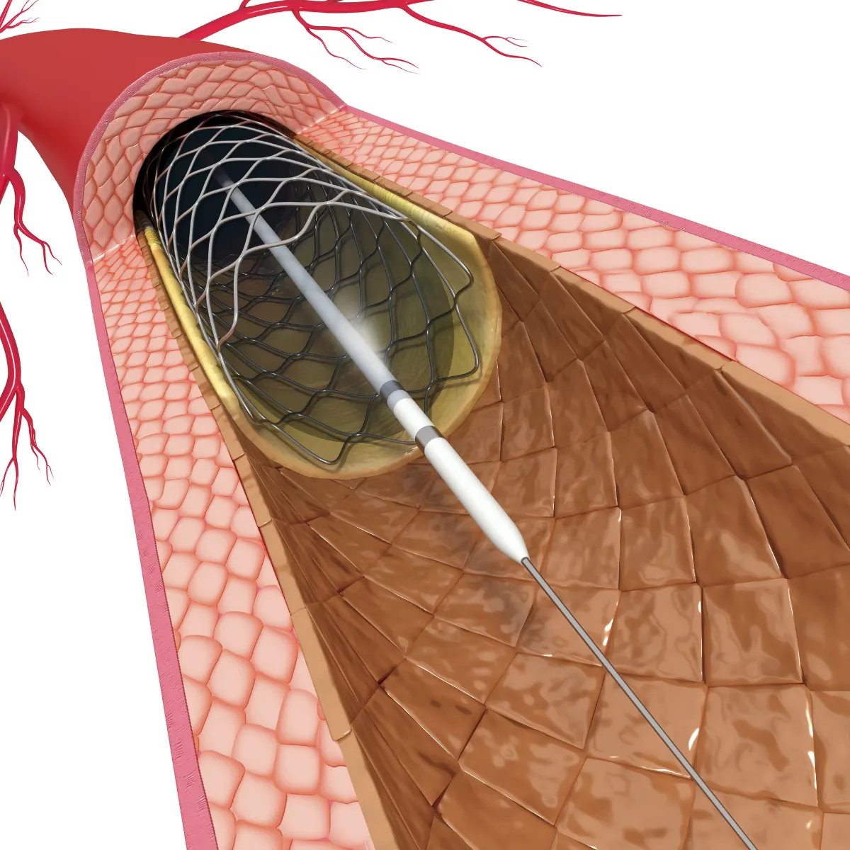 Cardiología Intervencionista y Hemodinámica